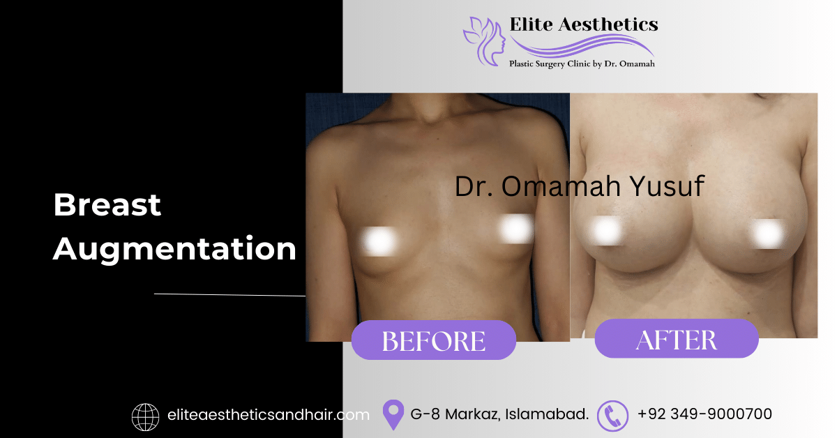 breast augmentation in islamabad
