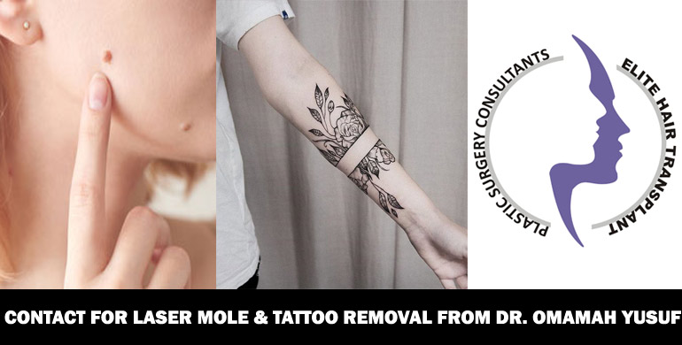 laser-mole-tattoo-removal-in-islamabad