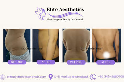 liposuction surgery by Dr. Omamah