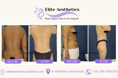 liposuction surgery by Dr. Omamah