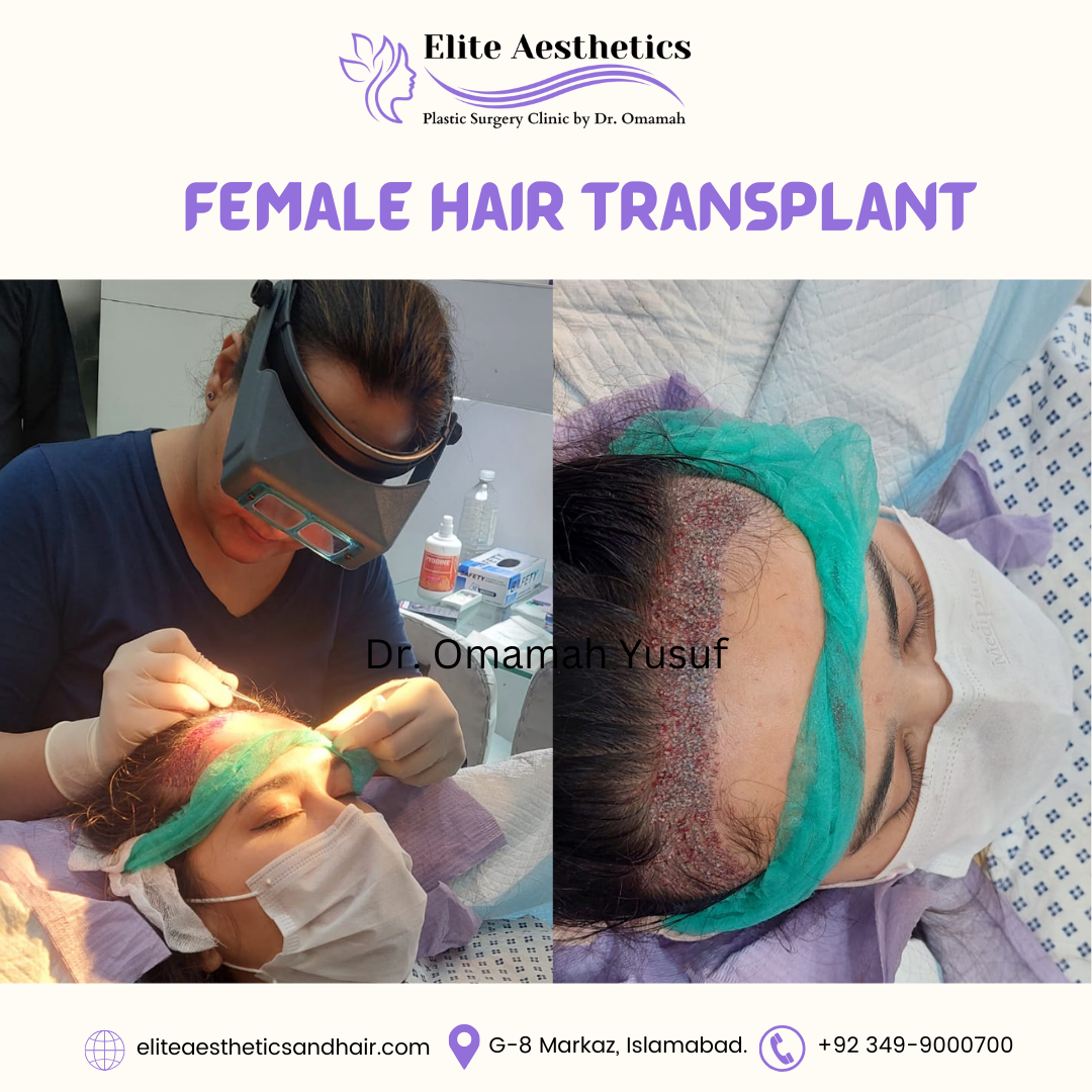 How Much Does a Hair Transplant Cost in Pakistan?