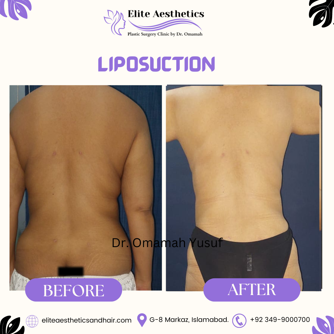 Is Liposuction a Safe Procedure?