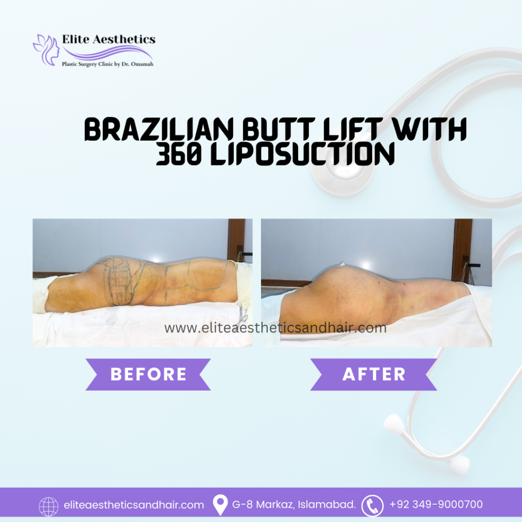 buttock augmentation