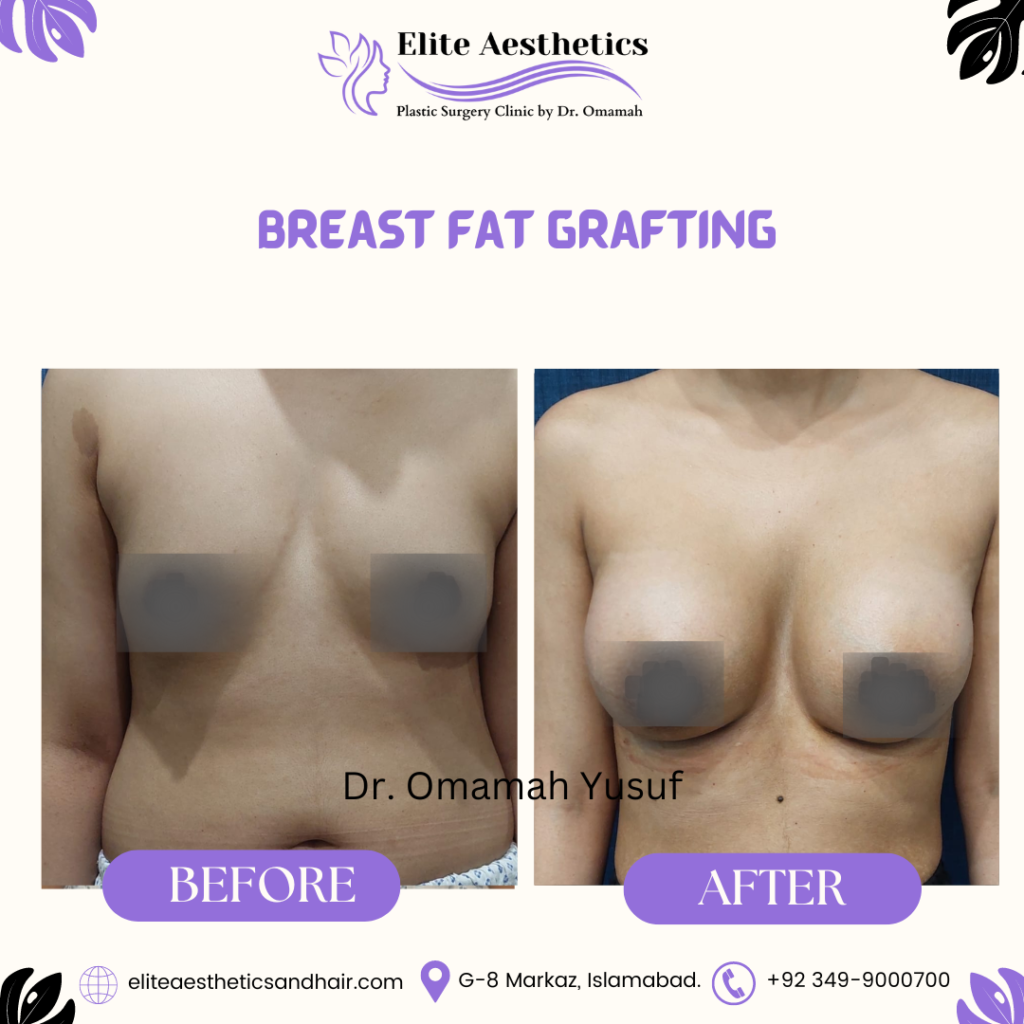 breast fat transfer