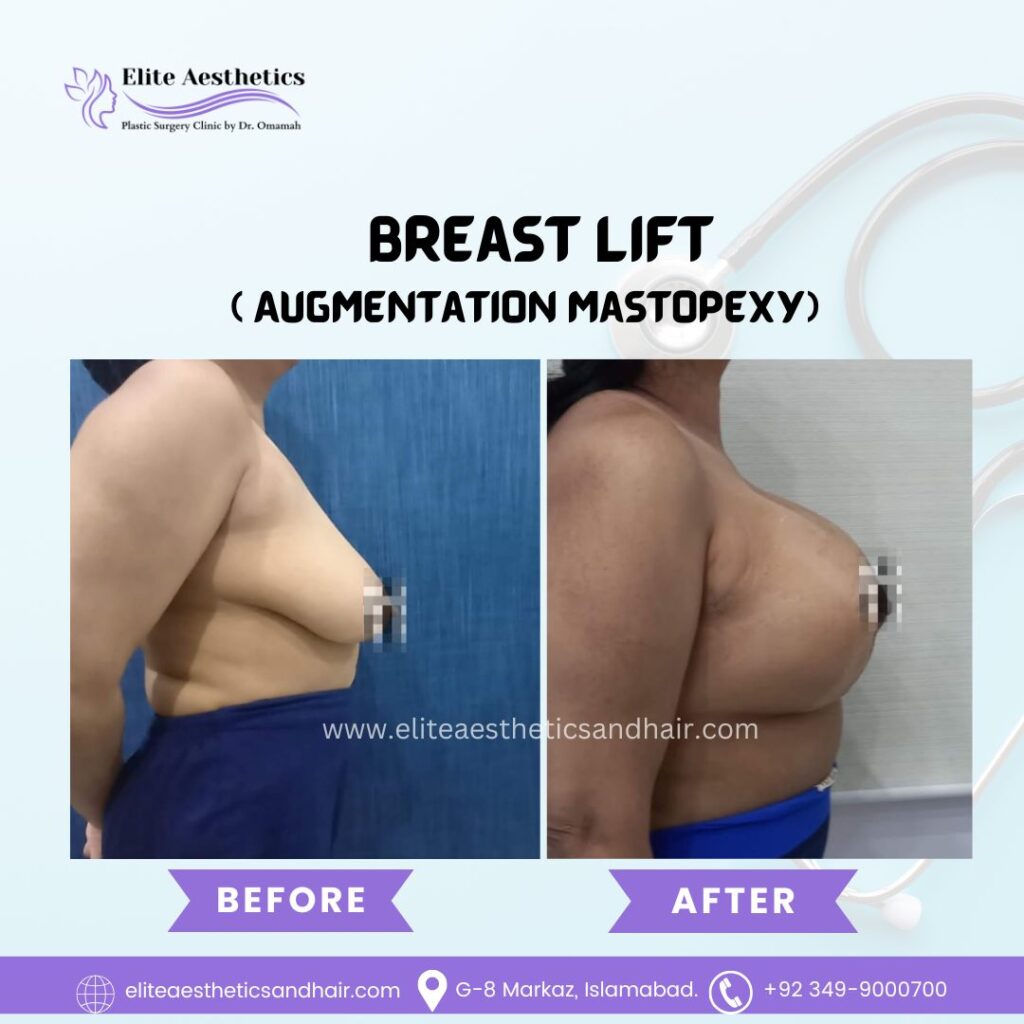 breast lift surgery