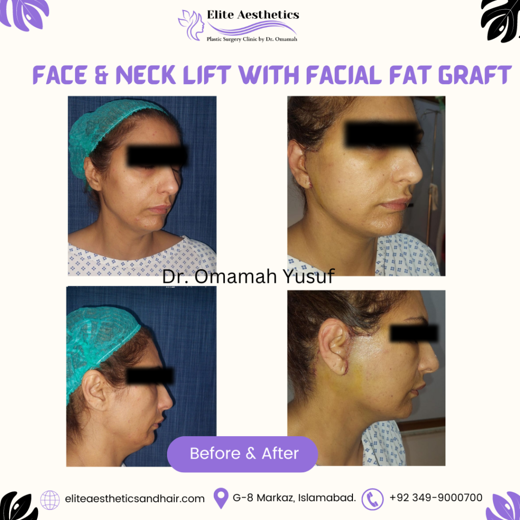 facial fat grafting